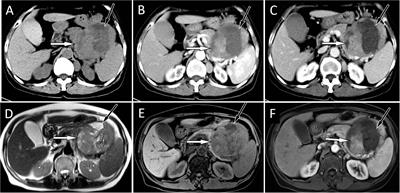 Multimodal imaging study of pancreatic myeloid sarcoma: a case report and literature review